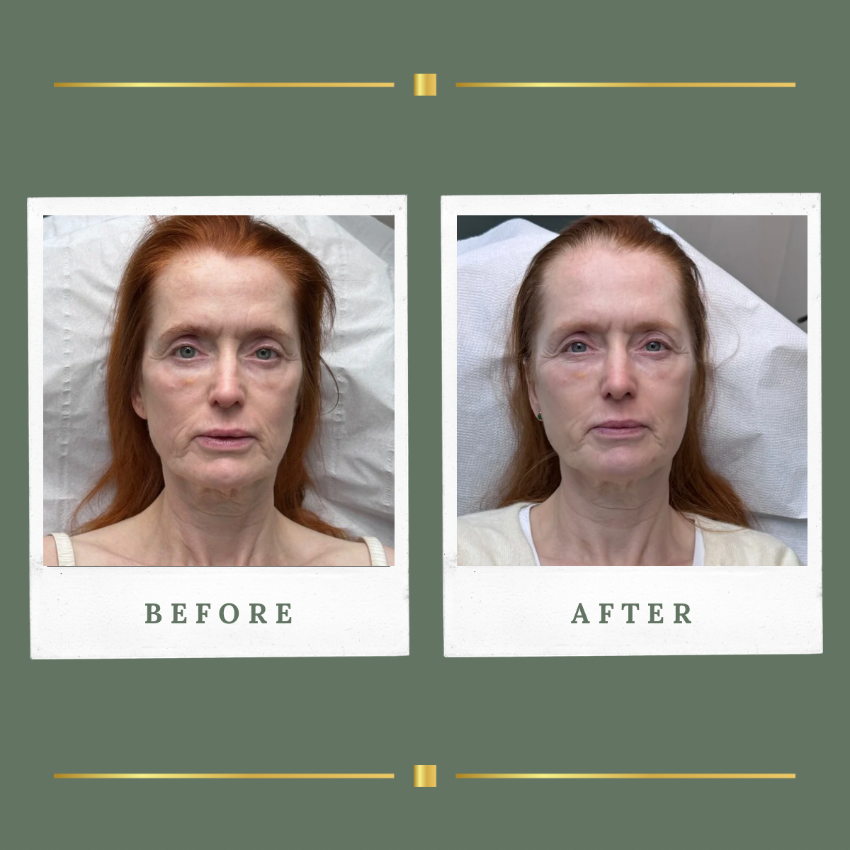 Front view before and after HIFU facelift result for a client from Mansfield
