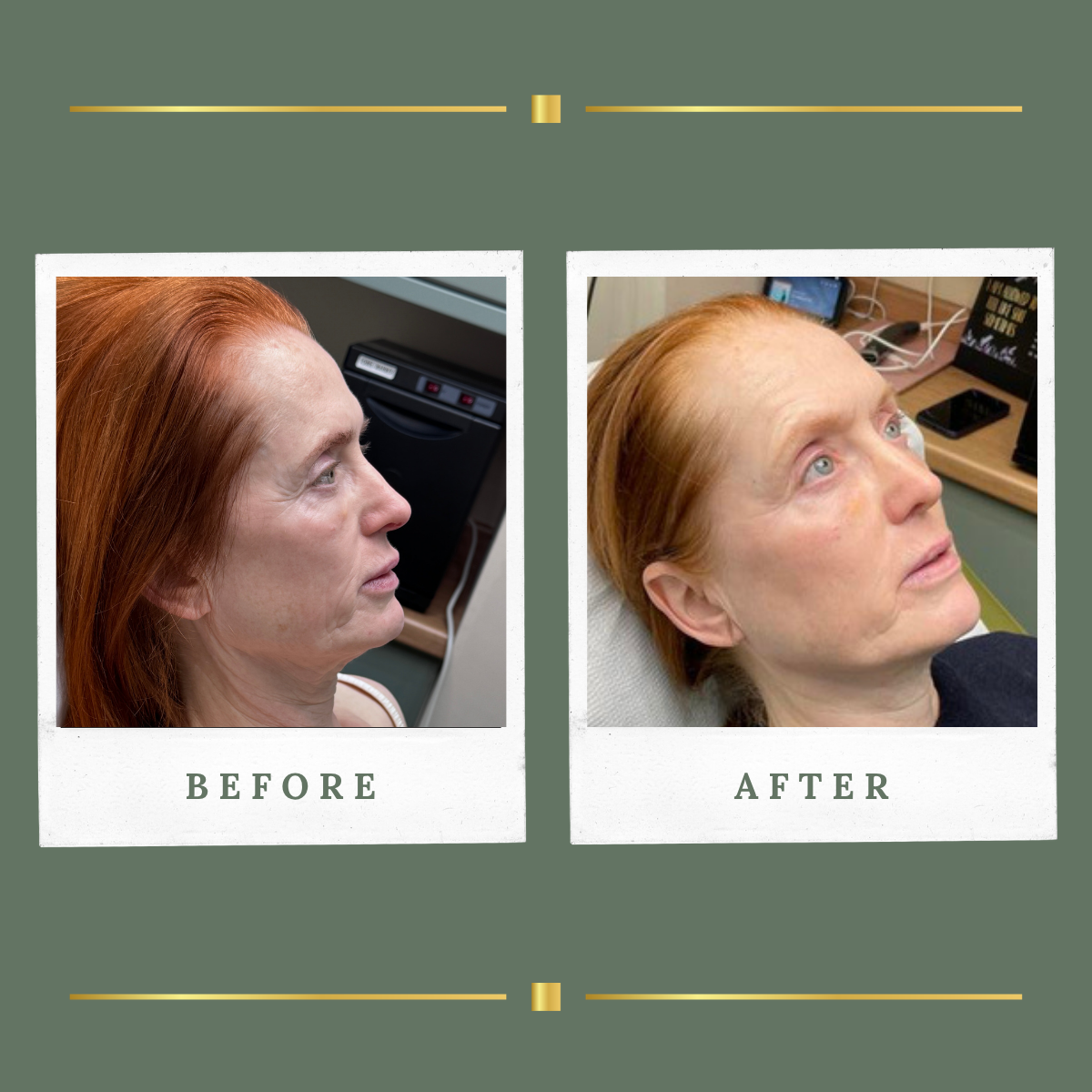 Skin transformation programme result at Rachel Aesthetics, Farnsfield