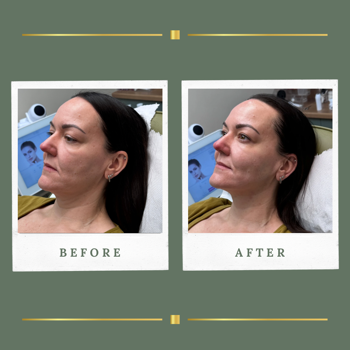 Profile before and after HIFU face tightening result for a client from Nottingham