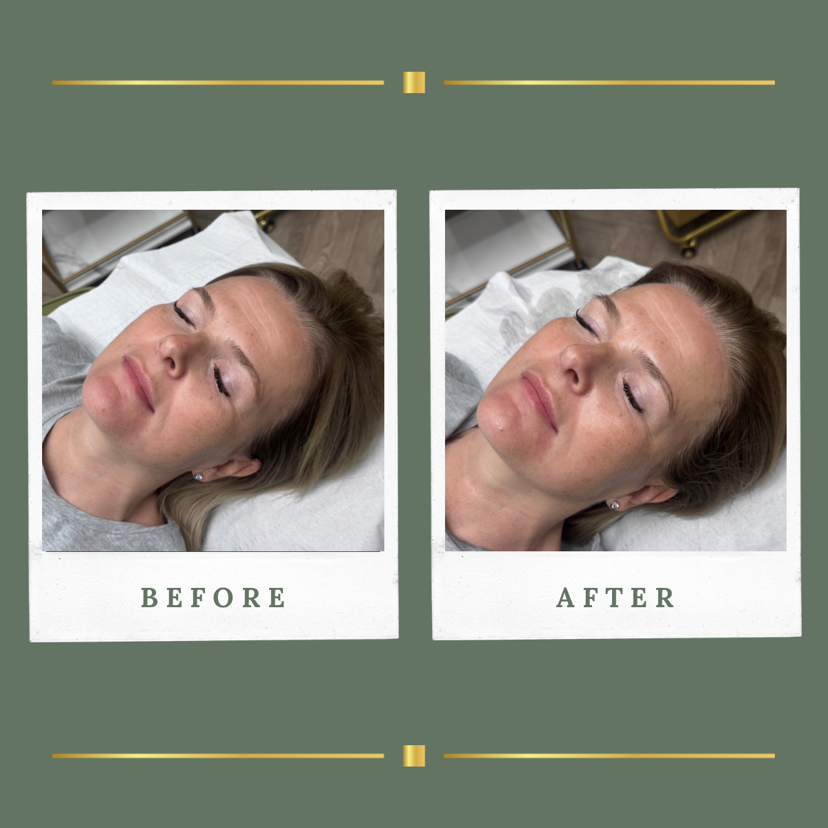 Side view before and after HIFU facial tightening result for a client from Mansfield