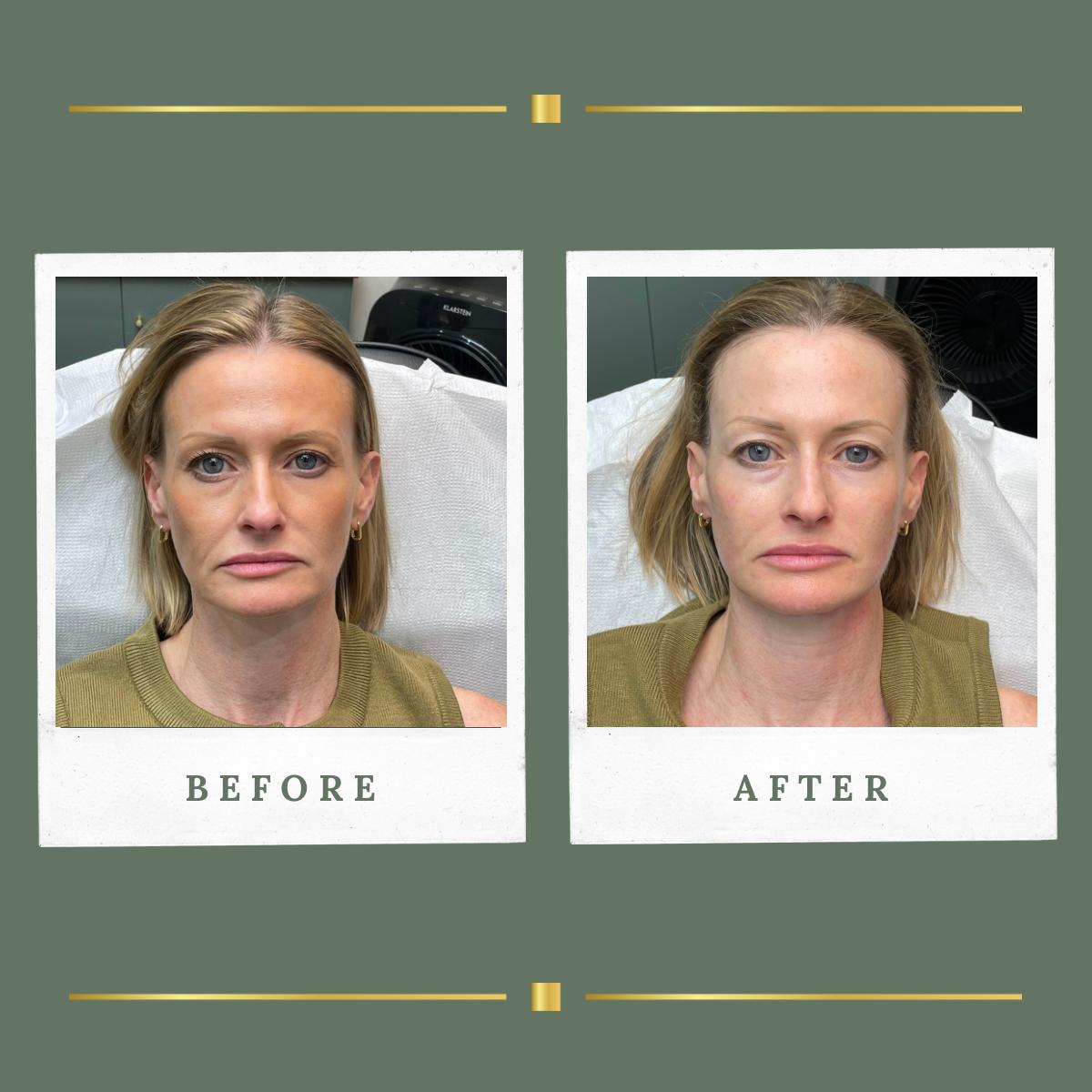 Front view before and after HIFU facelift result at Rachel Aesthetics, Farnsfield