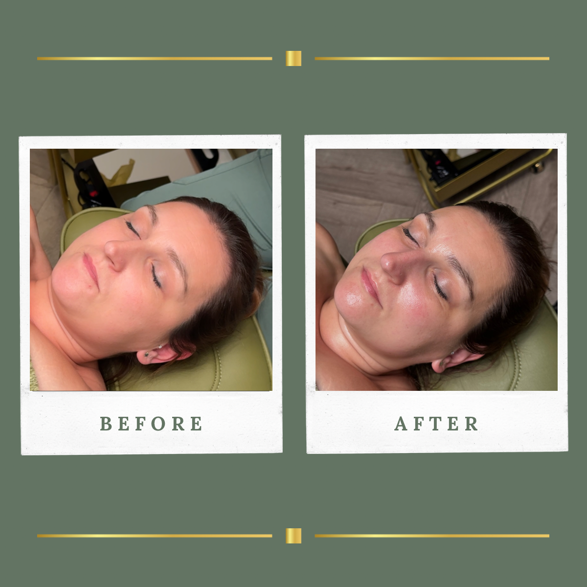 Before and after Korean facial result at Rachel Aesthetics, Nottinghamshire