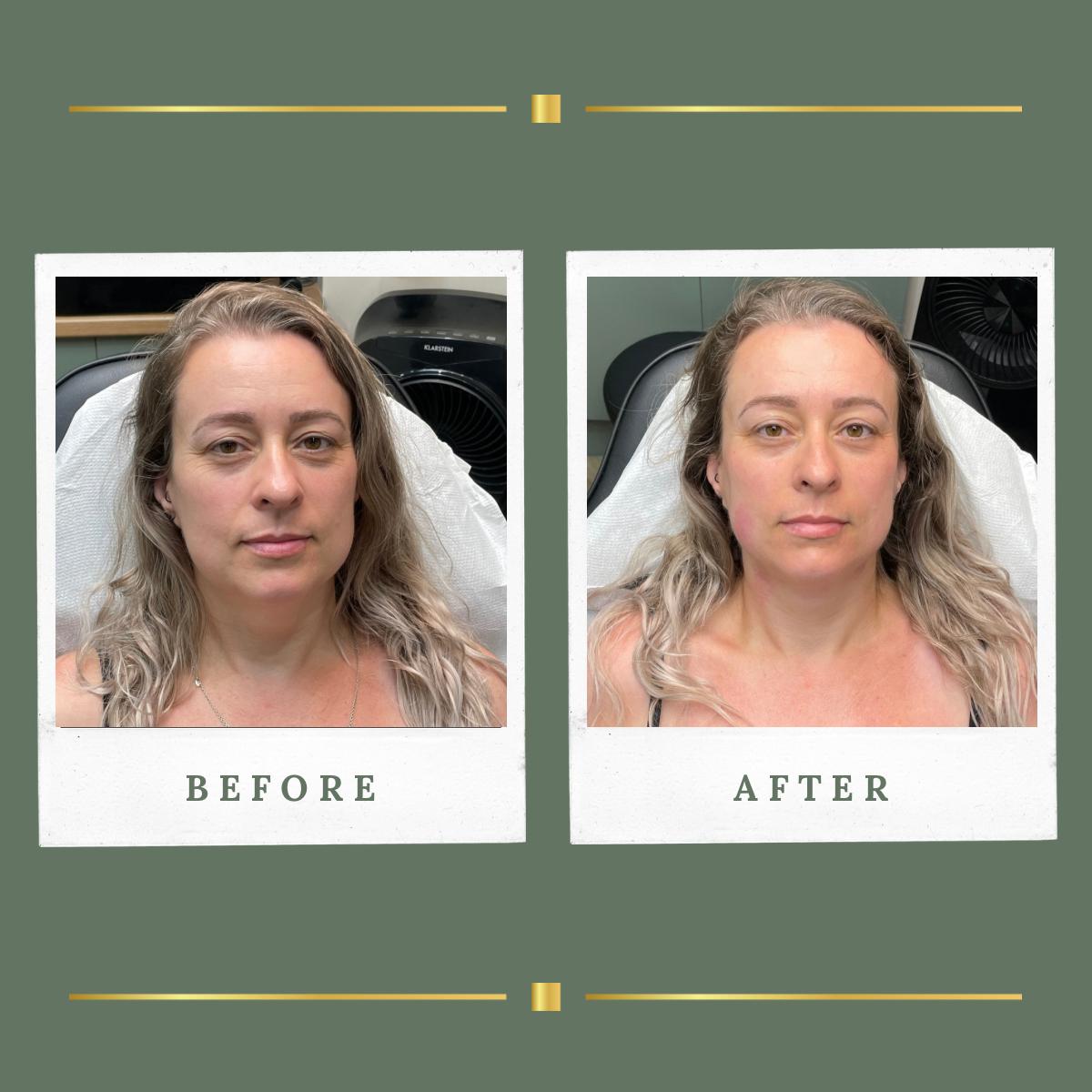 Front view before and after HIFU facial rejuvenation result at Rachel Aesthetics